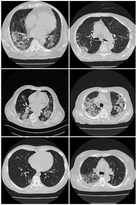 COVLIAS 3.0: cloud-based quantized hybrid UNet3+ deep learning for COVID-19 lesion detection in lung computed tomography